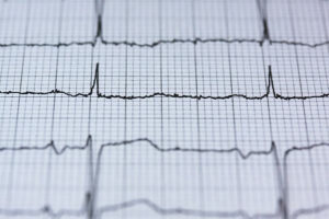 Herzfrequenz EKG