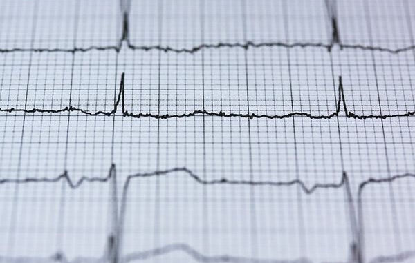 Herzfrequenz EKG